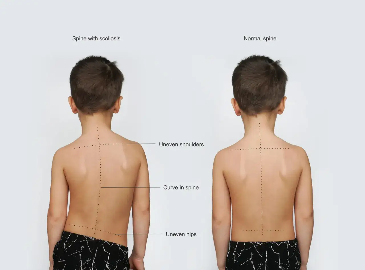Bambino con scoliosi: spalle e fianchi asimmetrici, colonna vertebrale curva. Confronto con colonna vertebrale normale. Sintomi scoliosi evidenti.
