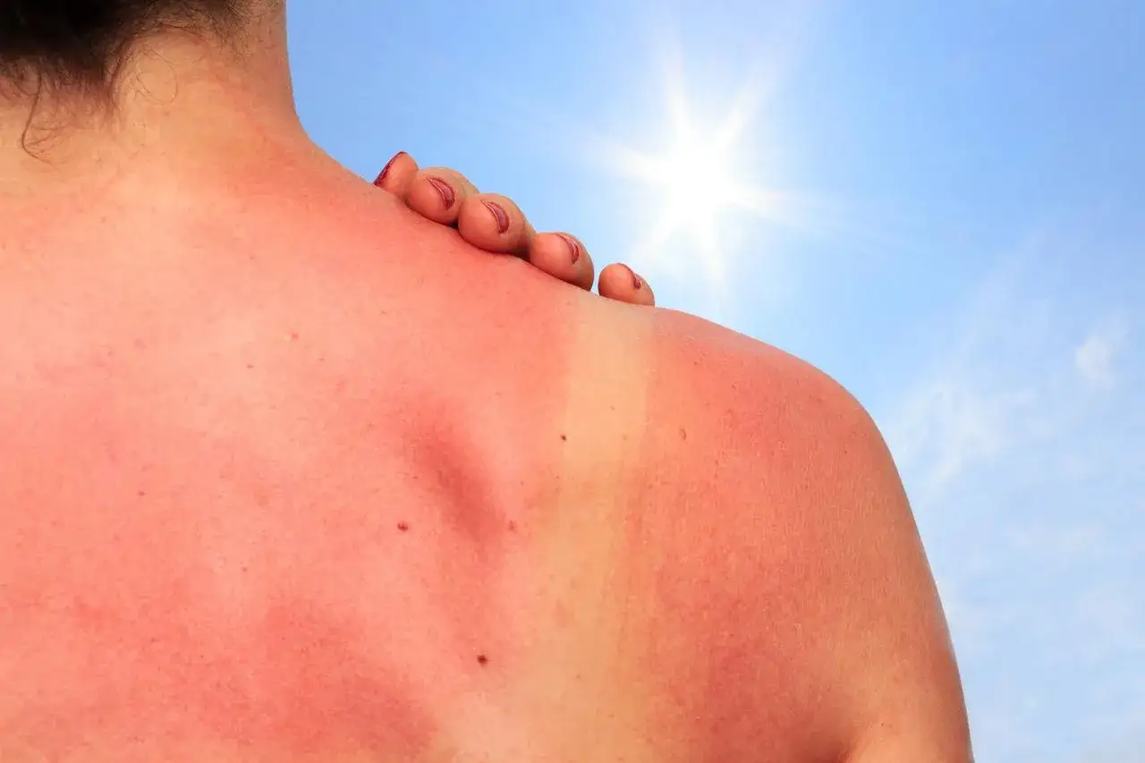 Coup de soleil sur l'épaule. Pour savoir comment faire dérougir un coup de soleil, appliquez une crème apaisante.