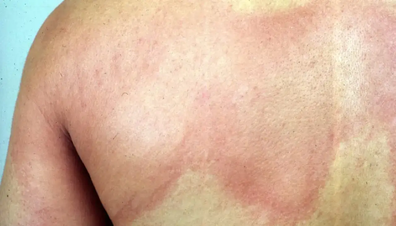 Peau rougie et enflammée, présentant des plaques d'urticaire. Recherche d'un urticaire traitement naturel pour apaiser ces rougeurs.