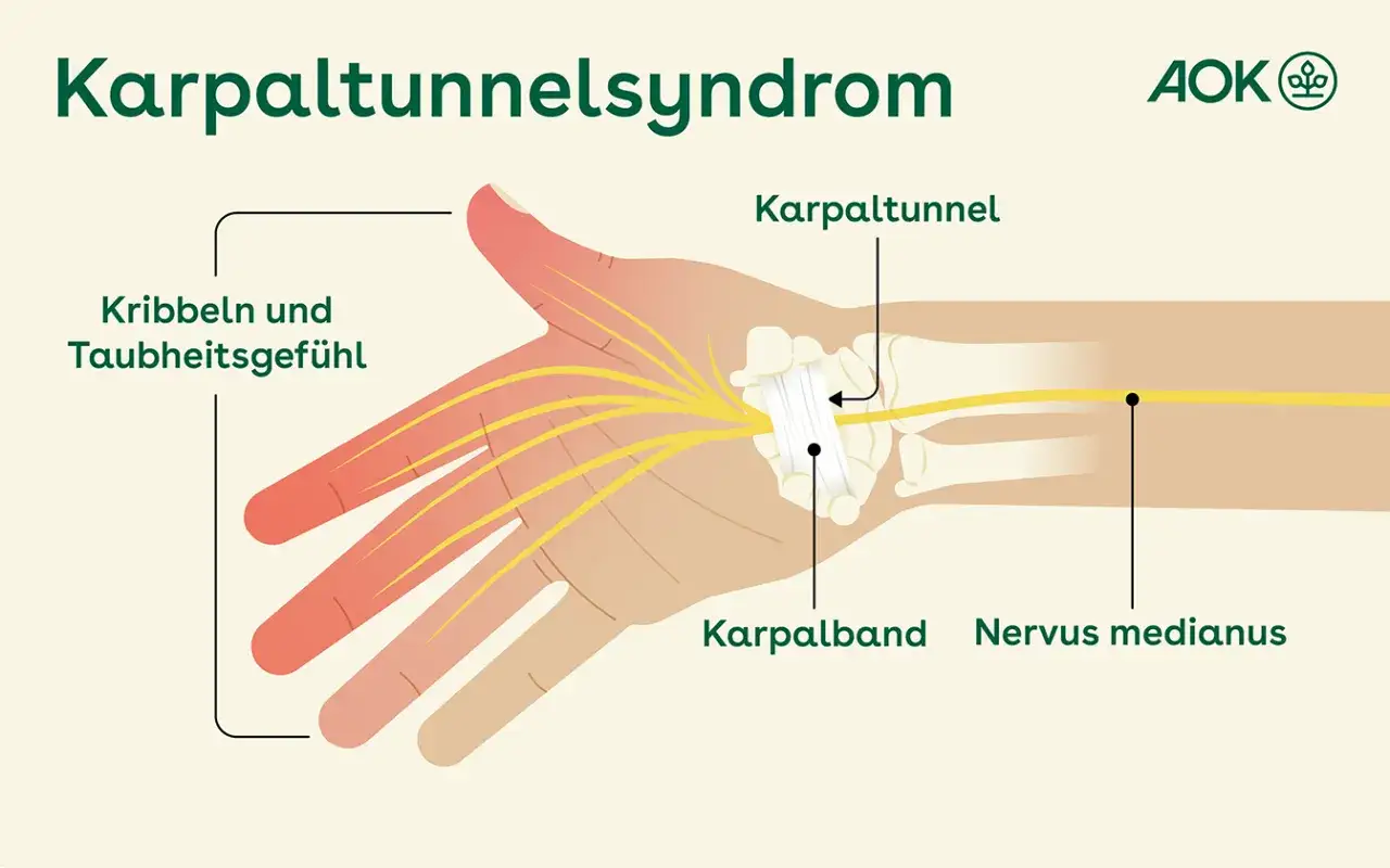 Karpaltunnelsyndrom: Nervus medianus im Karpaltunnel eingeengt, verursacht Kribbeln und Taubheitsgef&uuml;hl in den Fingern.