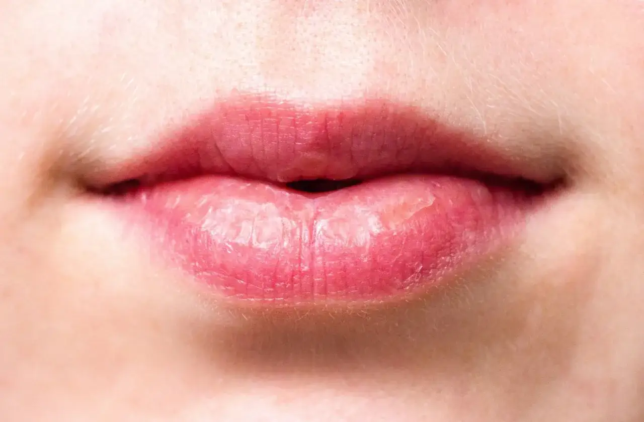 Labios rojos y agrietados, con zonas blanquecinas, evidencia de labios quemados por el sol tras un día de playa.