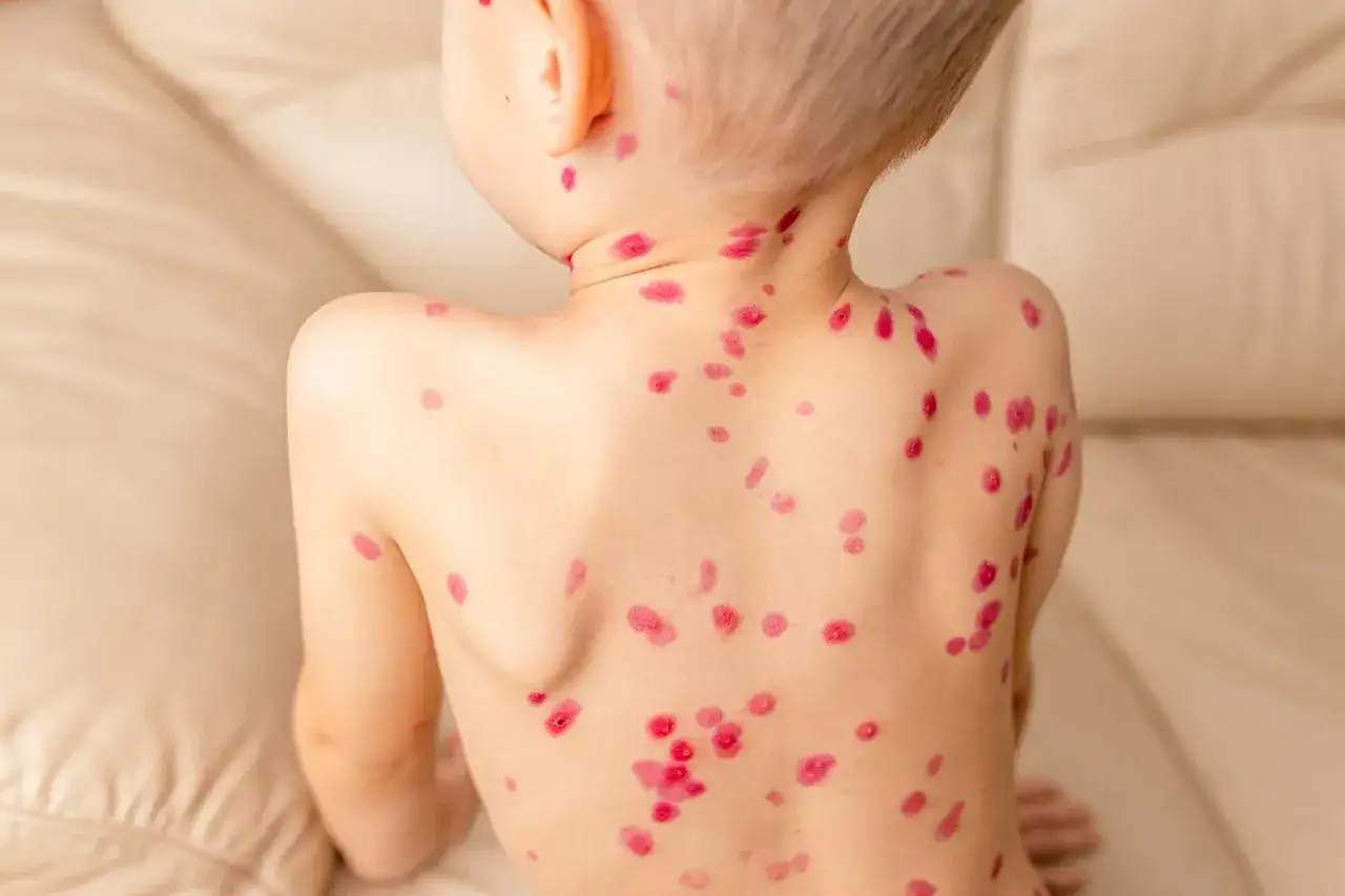 Niño con erupciones rojas y picazón en la espalda, mostrando las etapas de la varicela.