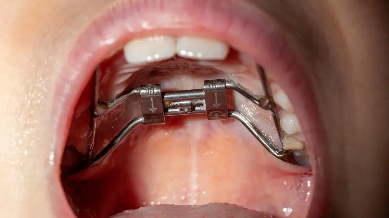Metalowy aparat ortodontyczny w jamie ustnej, pomagający w leczeniu przodozgryzu. Ćwiczenia z jego użyciem korygują wadę.