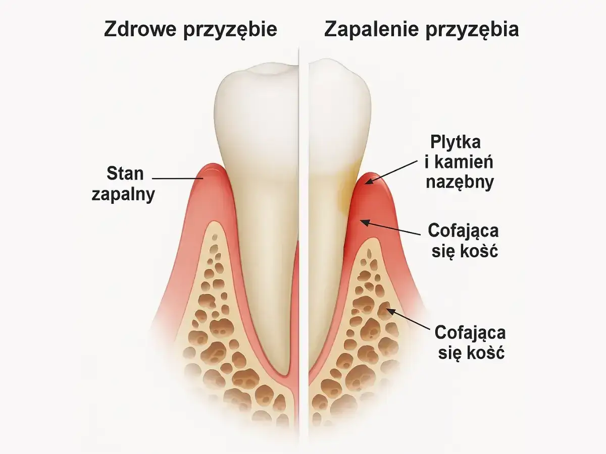 Porównanie zdrowego przyzębia z zapaleniem. W zapaleniu widoczna jest płytka nazębna i cofająca się kość.