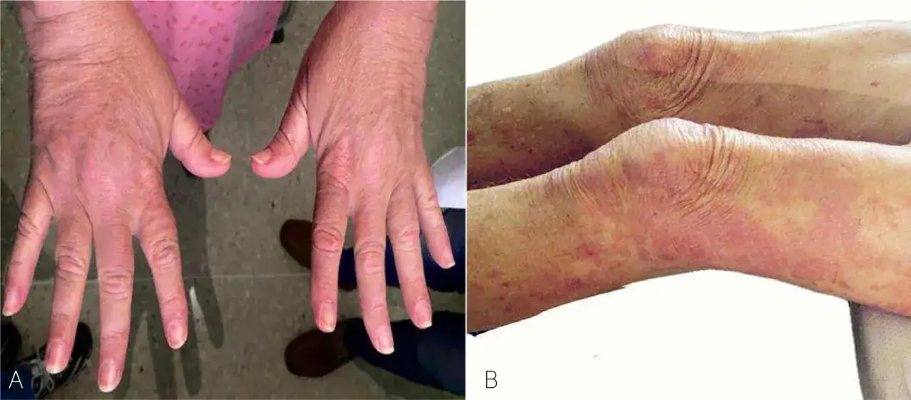 Manos con erupci&oacute;n y rodillas enrojecidas, s&iacute;ntomas de miositis que es una inflamaci&oacute;n muscular.