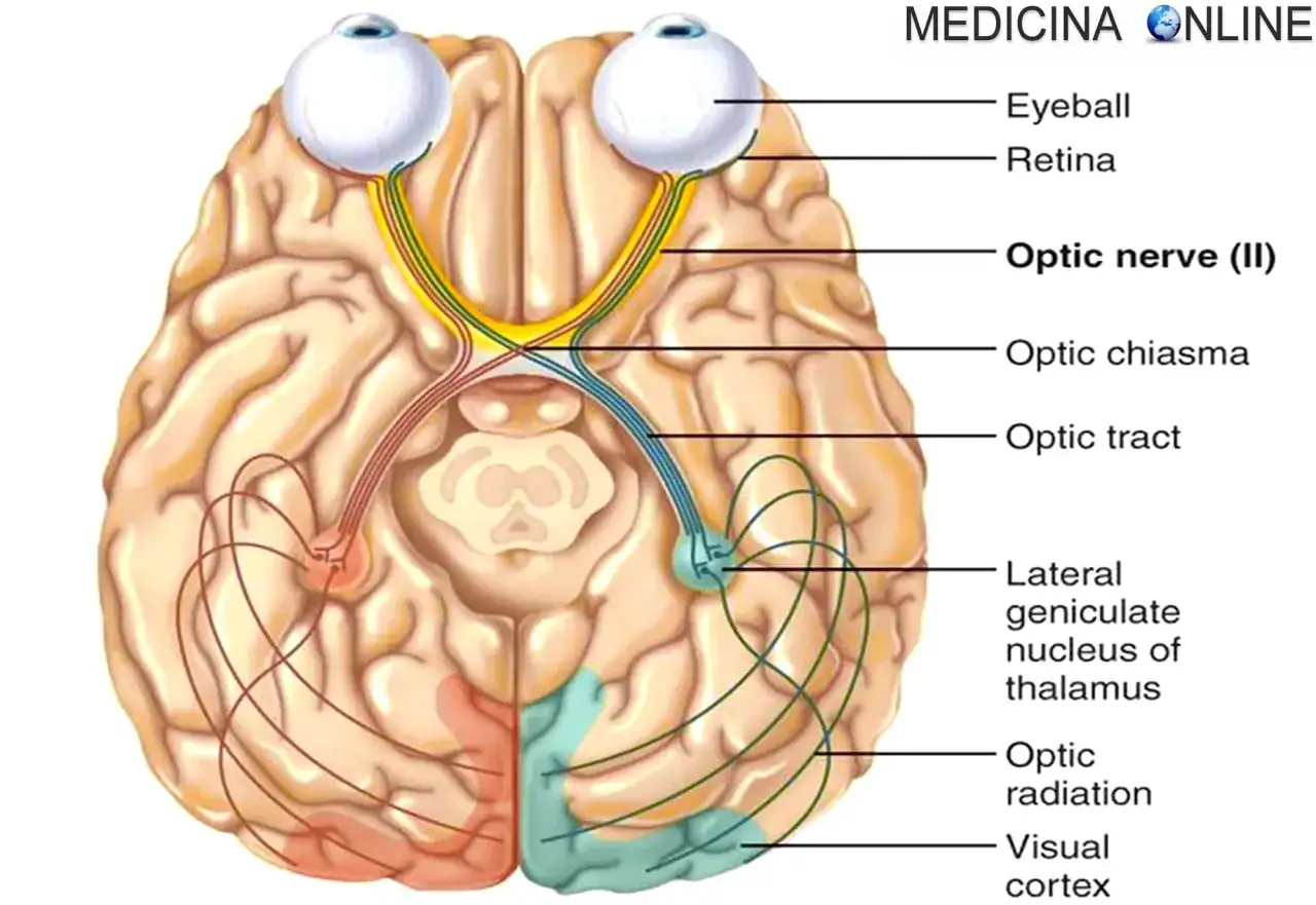 Diagramma del cervello che mostra il percorso della vista, dal bulbo oculare al lobo occipitale, evidenziando il neurite ottica.