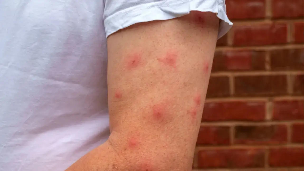 Bras couvert de rougeurs et de boutons de moustique qui ne partent pas, malgré les grattages.