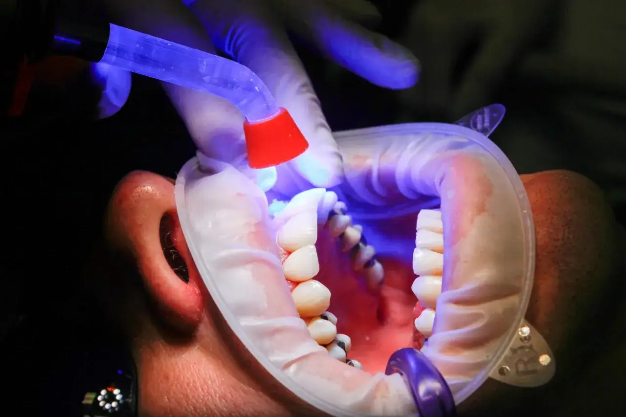 Dentysta używa lampy UV do utwardzenia wypełnienia podczas leczenia próchnicy.