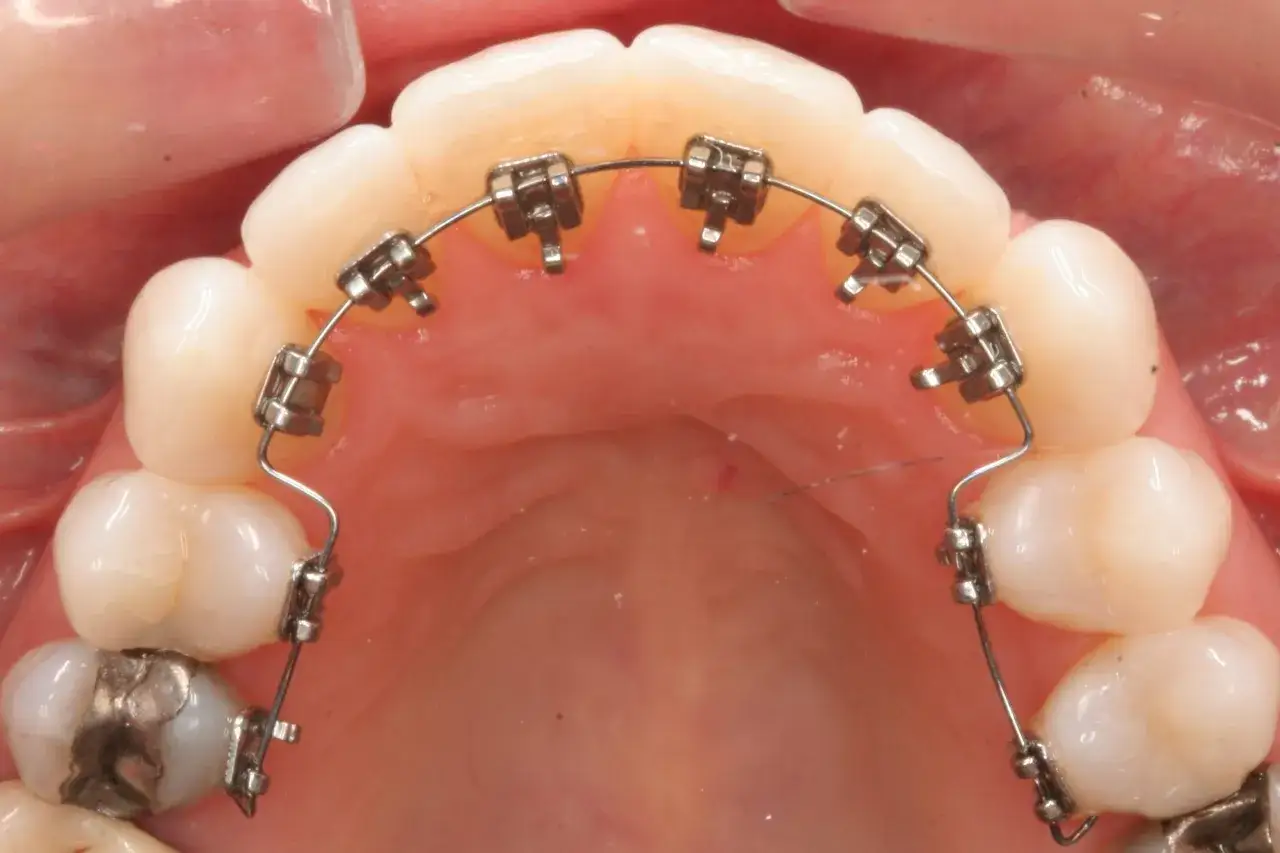 Apparecchio ortodontico con brackets metallici e filo curvo, un apparecchio per rieducare la lingua e correggere la posizione dei denti.