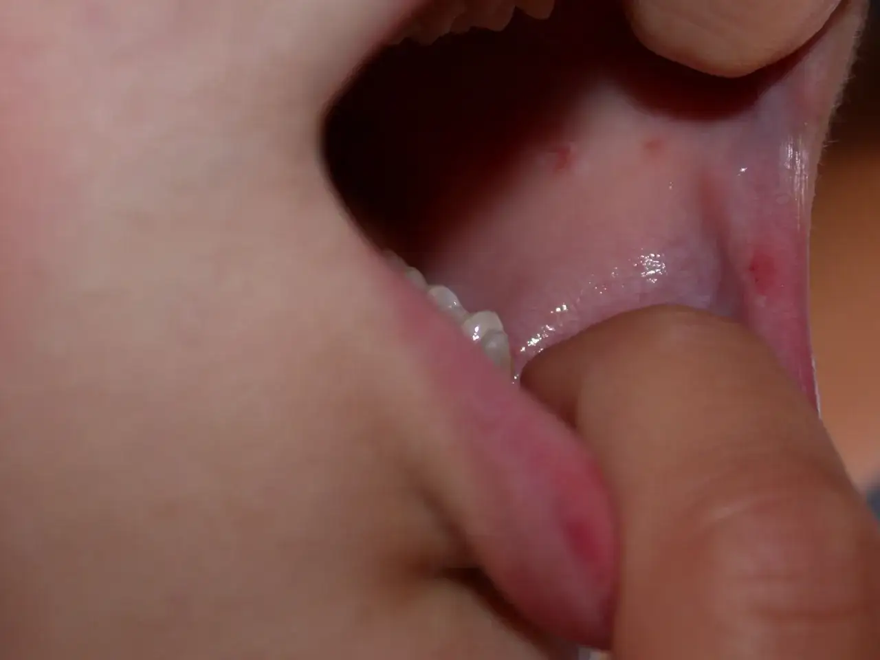 Piccolo afte guancia, con piccole lesioni rosse visibili all'interno della bocca.