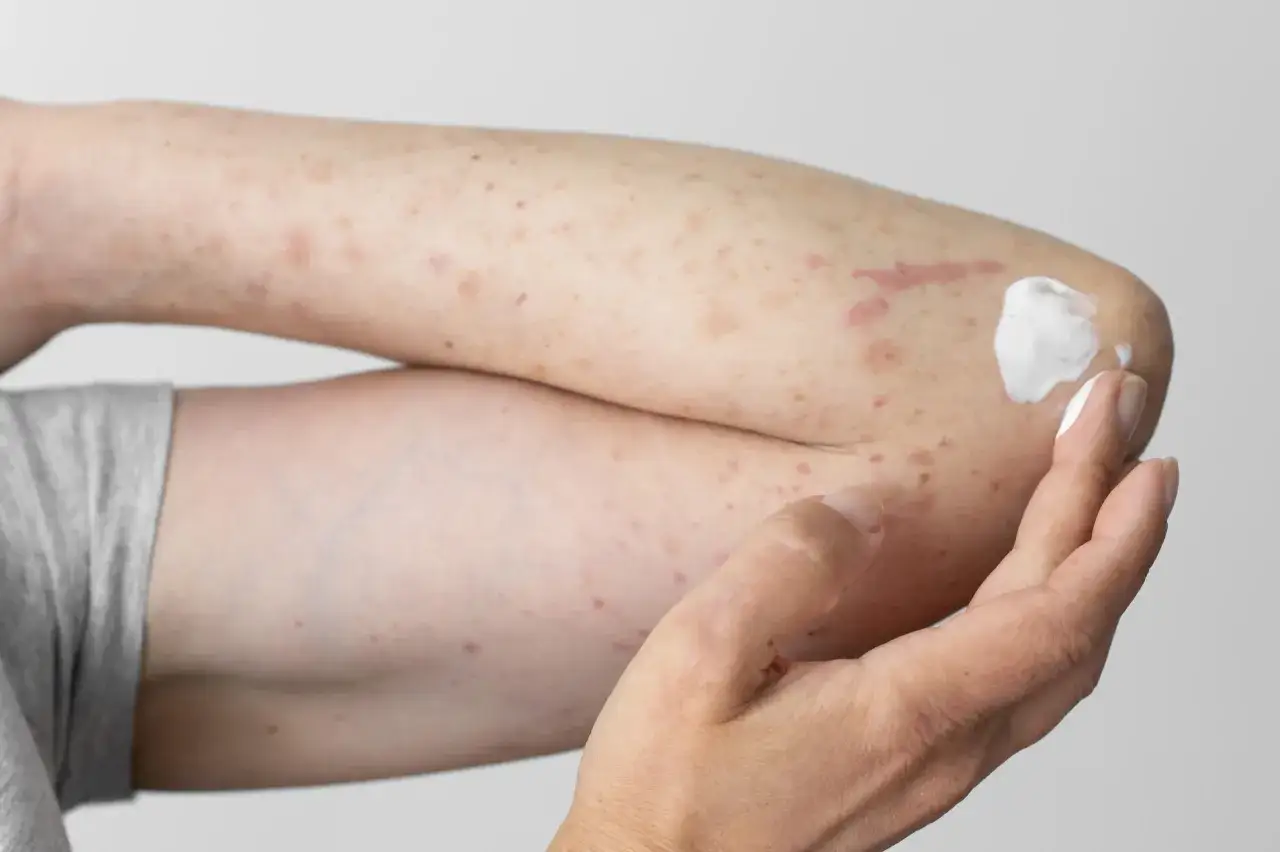 Arm mit Hautausschlag und Rötungen, mögliche geraniol allergie symptome. Eine Hand trägt eine weiße Creme auf.