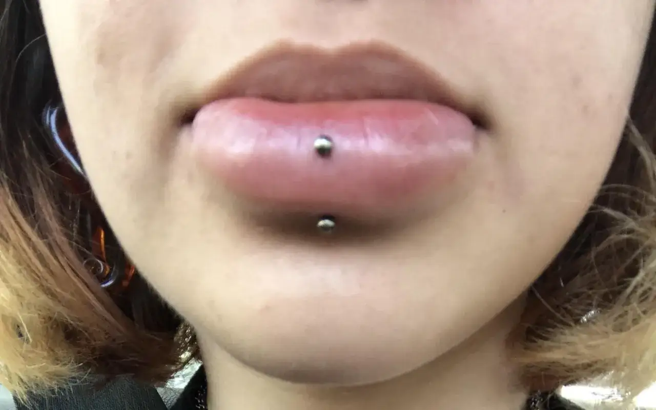 Zbliżenie na usta z pionowym labretem. Widoczne są dwa srebrne kółka, jedno na górnej wardze, drugie na dolnej. Proces vertical labret gojenie w toku.