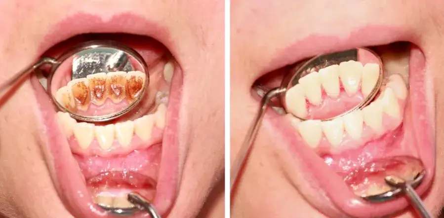 Wizyta u dentysty higienizacja zębów