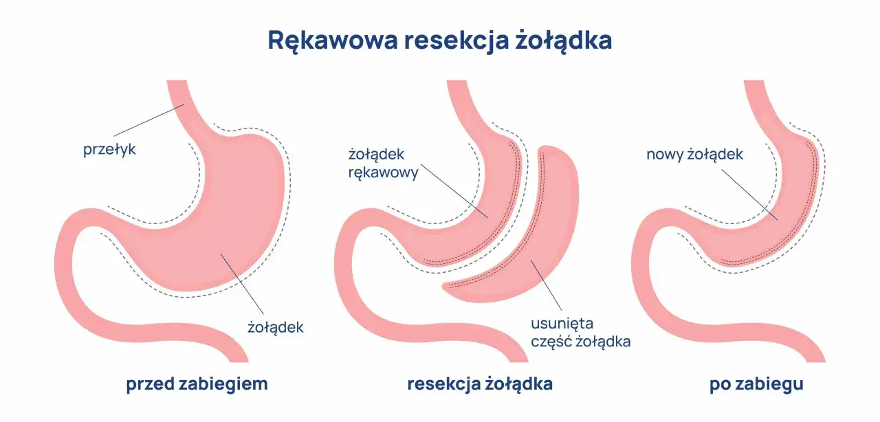 rodzaje operacji bariatrycznych schemat