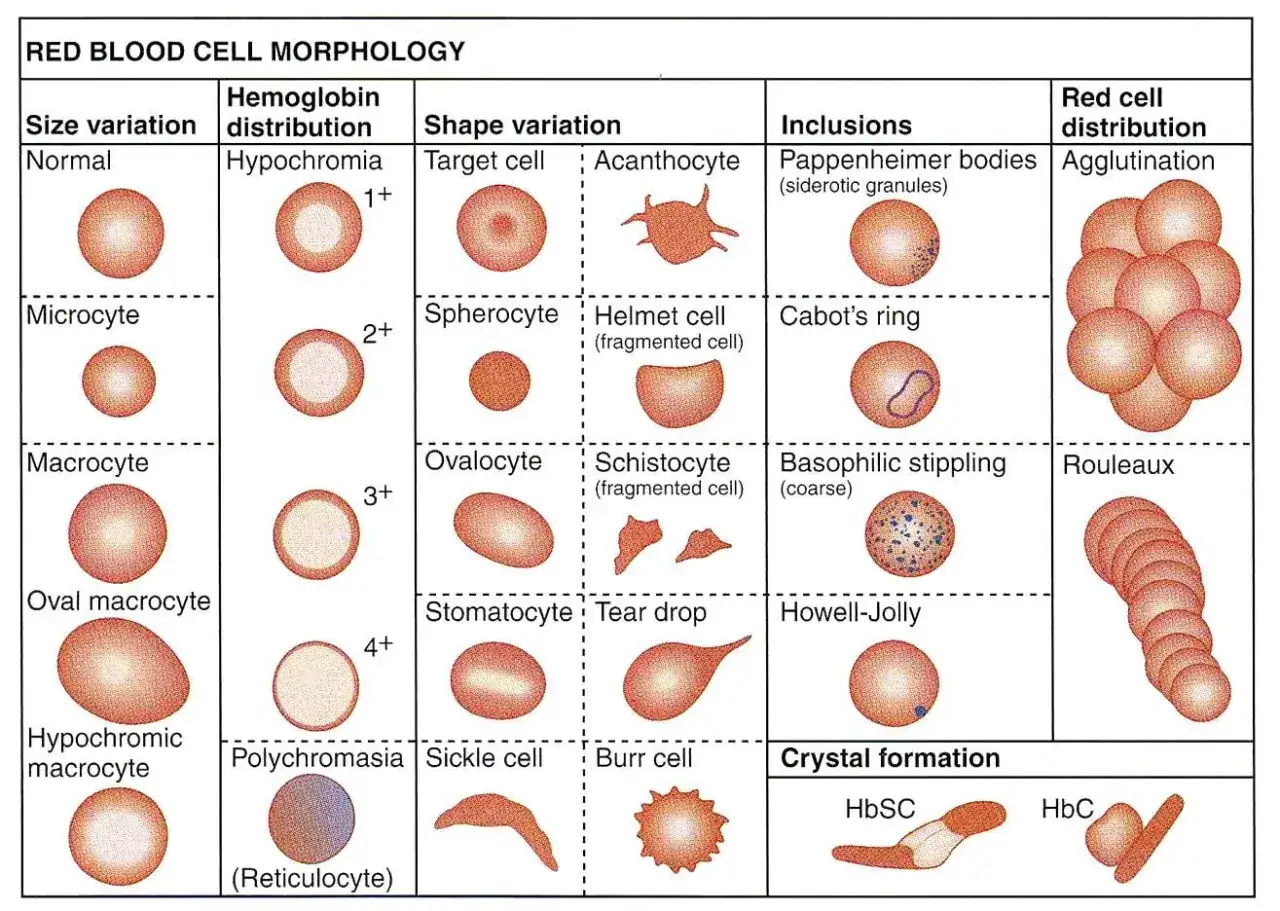 Schemat morfologii erytrocytów: rozmiar, dystrybucja hemoglobiny (np. hipochromia), kształt (np. komórka tarczowata, sierpowata), wtręty (np. ciałka Pappenheimera) i dystrybucja (aglutynacja, RDW-CV).