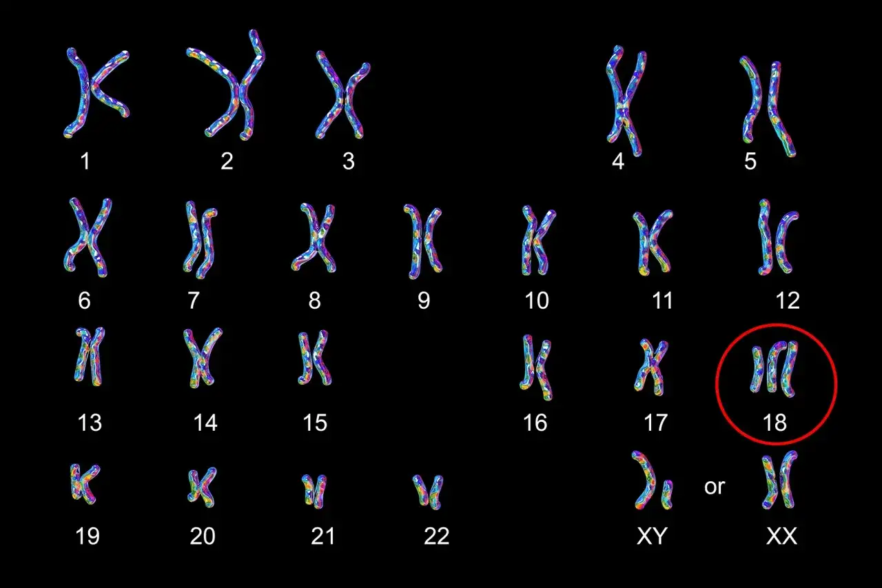 Kariotyp z trisomią chromosomu 18, czyli zespół Edwardsa. Widoczne pary chromosomów od 1 do 22 oraz chromosomy płci XY lub XX.