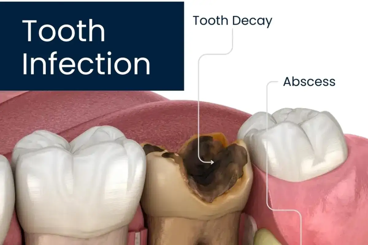 Diente con caries avanzada y absceso, mostrando las consecuencias de no tratar una infección dental.
