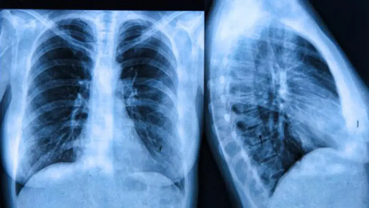 Radiografías de tórax, frontal y lateral, mostrando posibles signos de fibrosis quística.