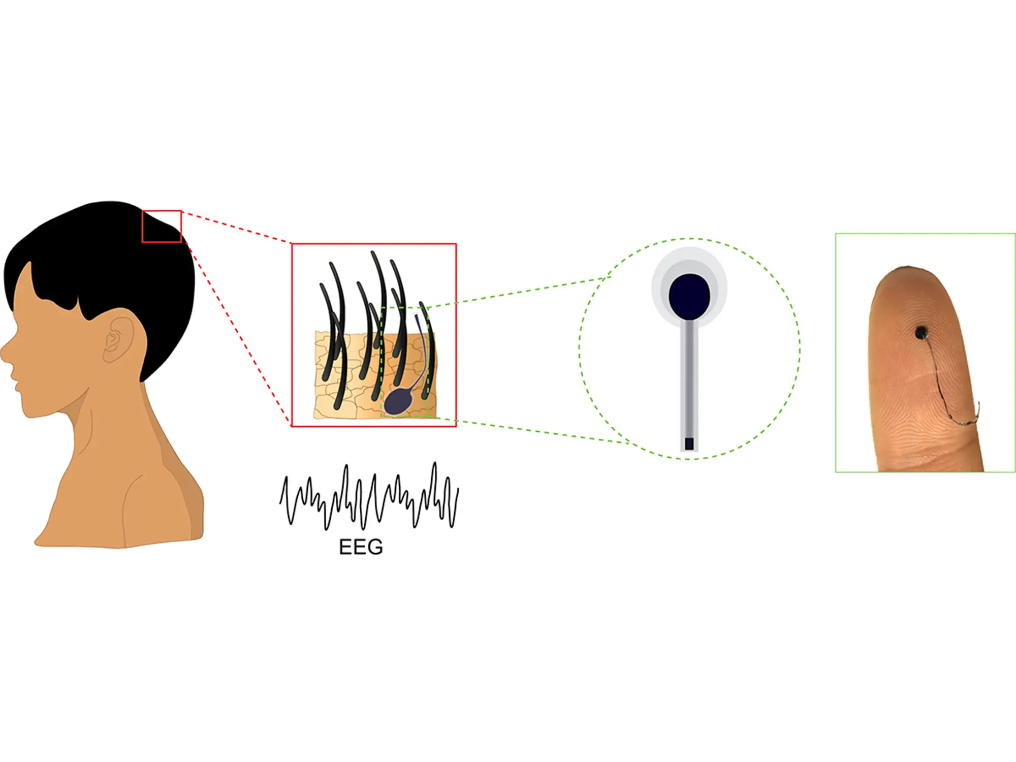 Illustration zeigt eine eeg untersuchung. Ein winziger Sensor wird an einem Haar befestigt, um Gehirnaktivität zu messen.