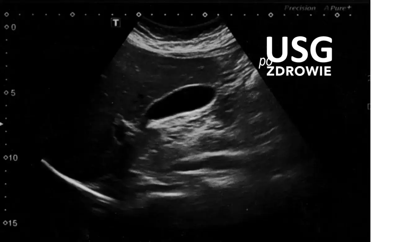 USG pęcherzyka ż&oacute;łciowego. Widoczne ciemne owalne kształty, kt&oacute;re mogą wskazywać na kamienie ż&oacute;łciowe objawy.