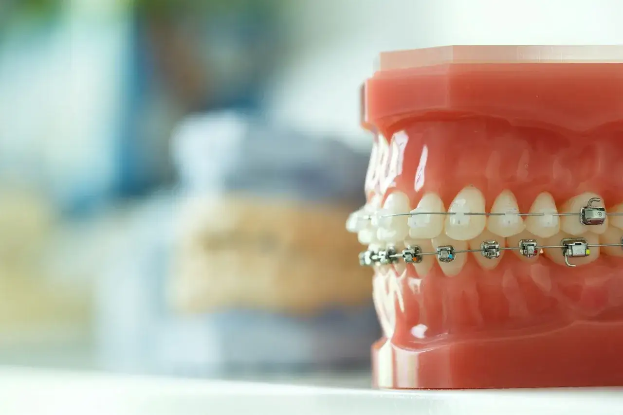 Model szczęki z zębami i założonym aparatem ortodontycznym. Ten wieloczynnościowy aparat dentystyczny pokazuje postęp w leczeniu.