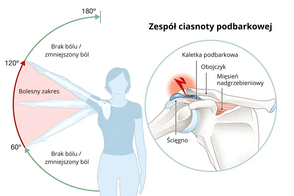 Anatomia barku i zespół ciasnoty podbarkowej