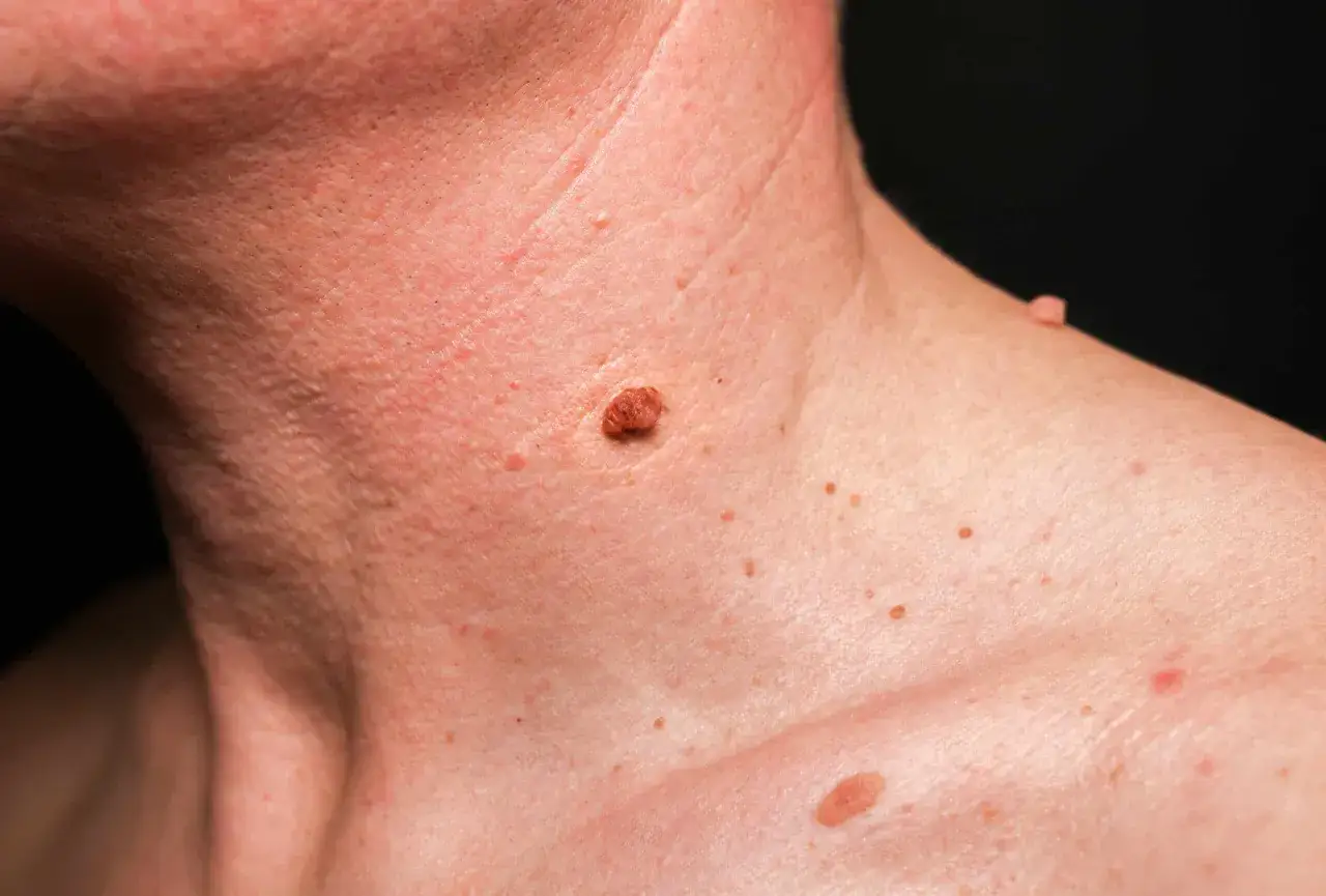 Gros plan sur la peau du cou, montrant plusieurs grains de beauté et un bouton qui ne part pas, de couleur brune et légèrement surélevé.