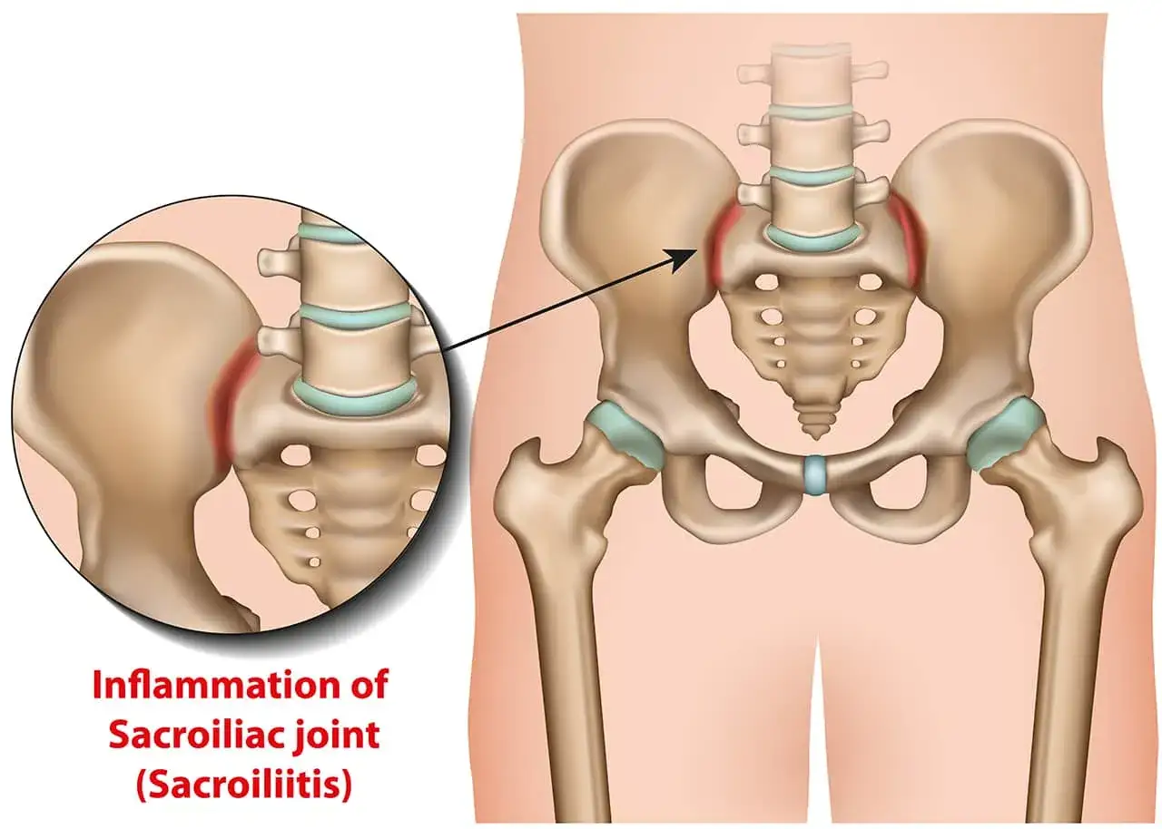 Illustration de l'inflammation de l'articulation sacro-iliaque, cause d'un muscle fessier douloureux.