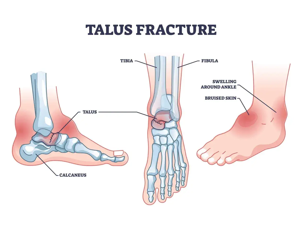 Fracture du talus, un os de la cheville, montrant le gonflement et la peau meurtrie.