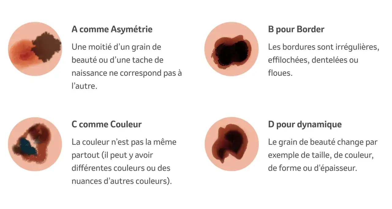 Illustration des caract&eacute;ristiques d'un grain de beaut&eacute; suspect : asym&eacute;trie, bordures irr&eacute;guli&egrave;res, couleurs vari&eacute;es et &eacute;volution dynamique.