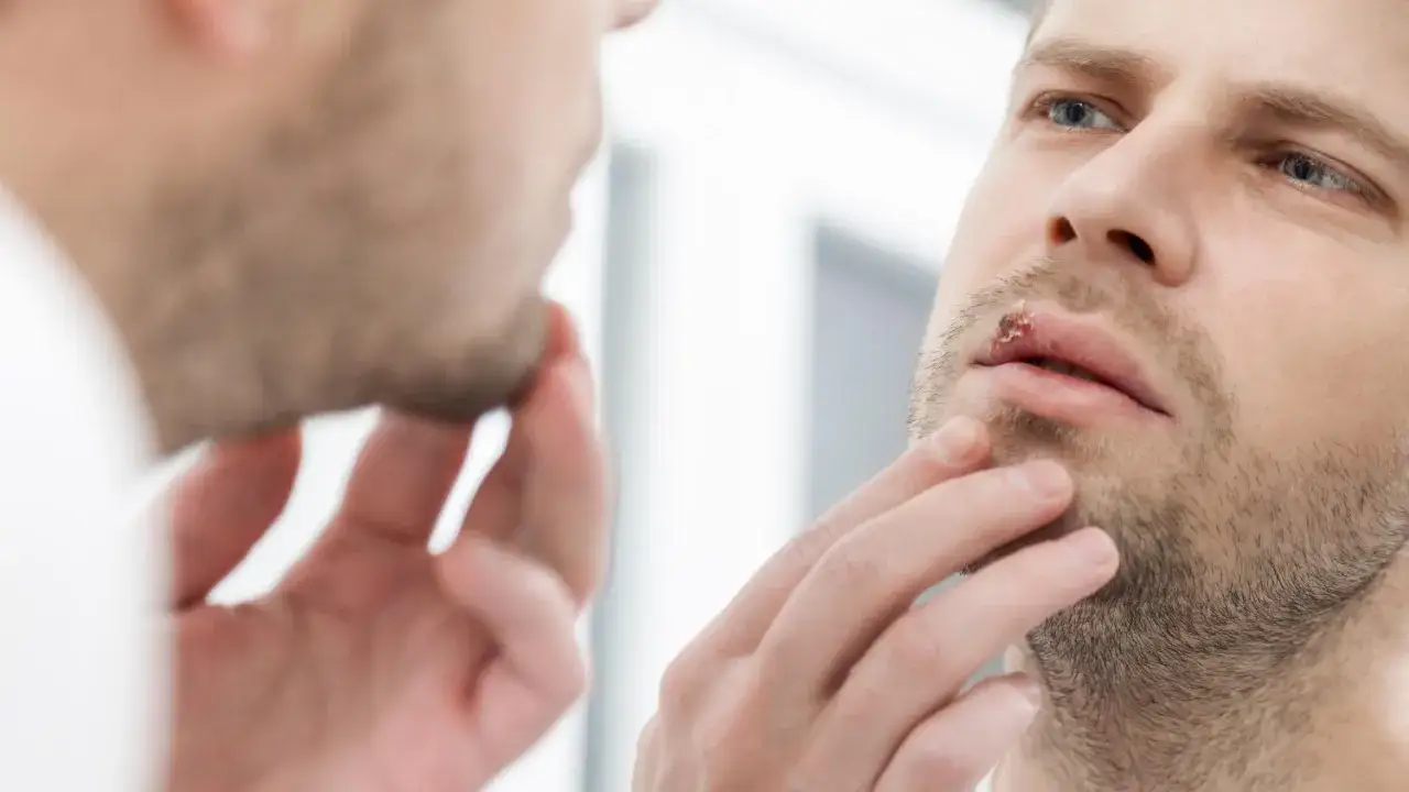 Mężczyzna z opryszczką na ustach zastanawia się, czy można iść do dentysty.
