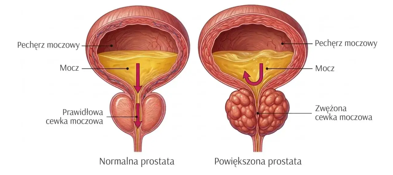 Porównanie prawidłowej i powiększonej prostaty. Powiększona prostata uciska cewkę moczową, utrudniając przepływ moczu z pęcherza.