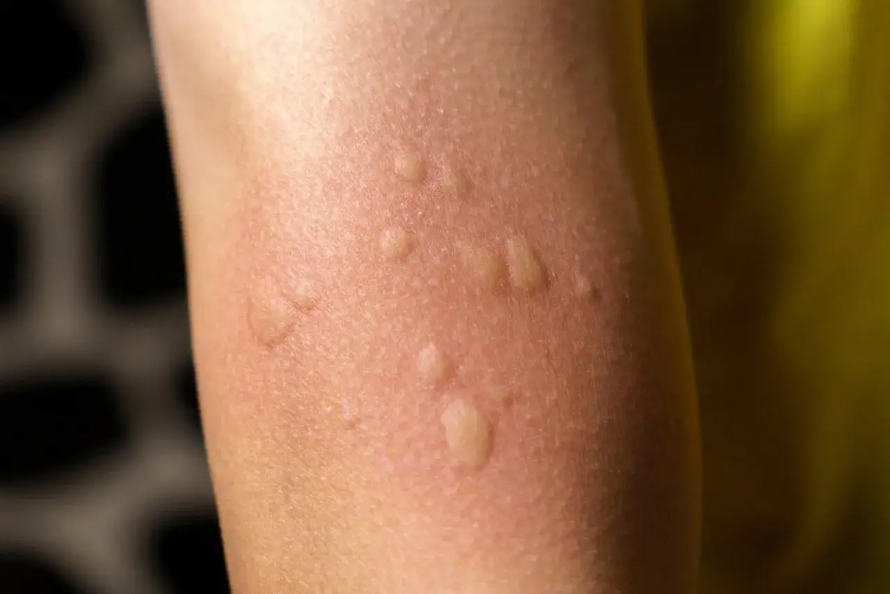 Pelle arrossata con pomfi gonfi, tipici di orticaria gigante nei bambini.