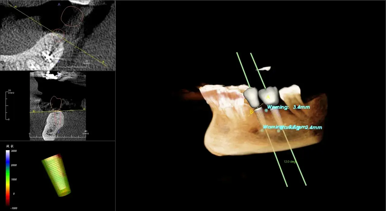 Pianificazione di implantologia dentale arcata inferiore con simulazione 3D e misurazioni precise.