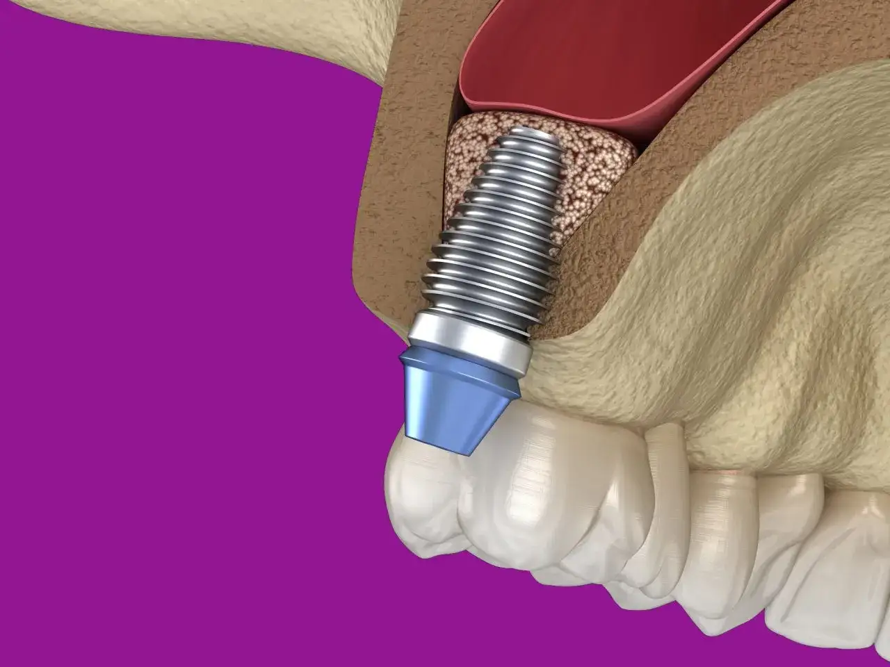Ilustracja pokazuje implant zębowy umieszczony w kości szczęki po zabiegu sinus lift otwarty.