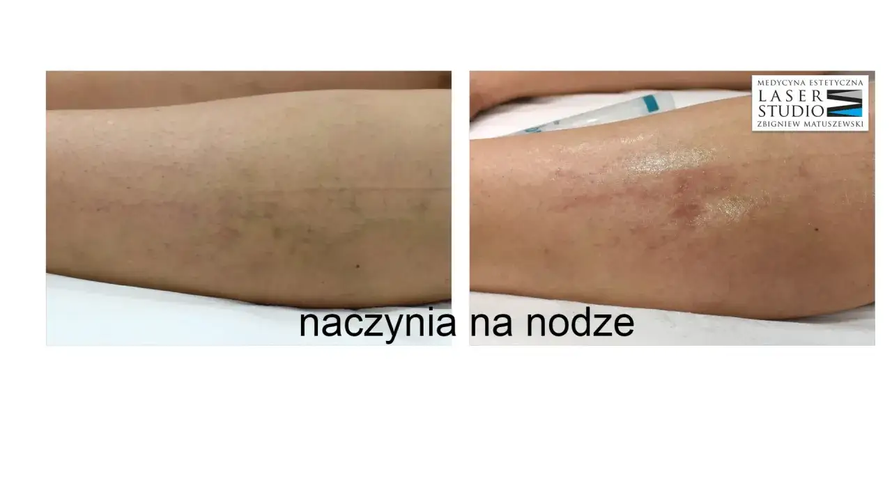 Przed i po zabiegu laserem na naczynka na nodze. Sk&oacute;ra po laseroterapii jest gładka, bez widocznych naczynek.