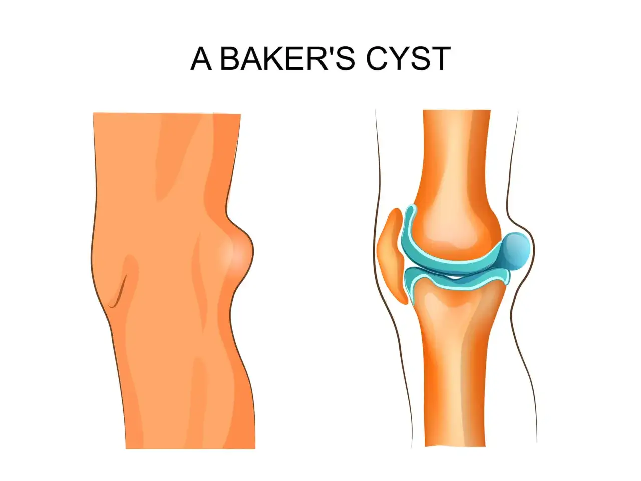 Illustrazione di una ciste di Baker sul ginocchio, con sezione che mostra la cavità articolare e la sacca cistica. Utile per capire come sfiammare ciste di Baker.
