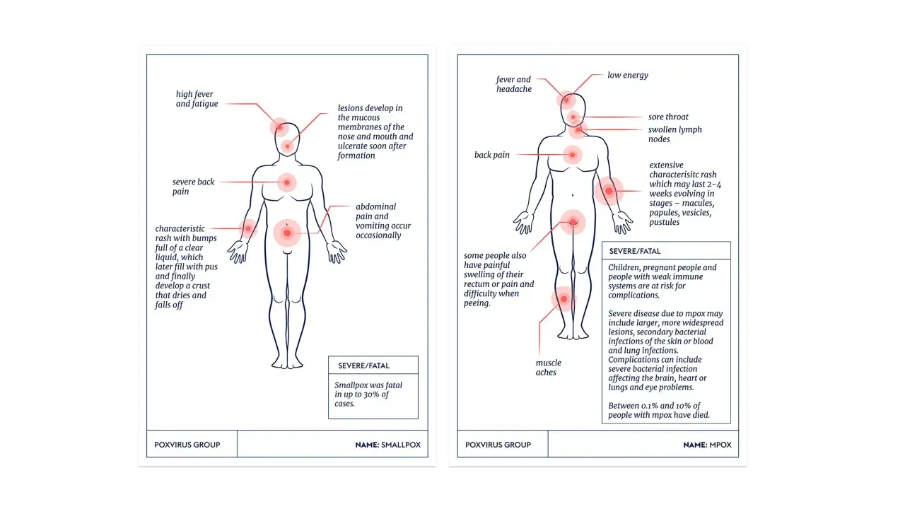 Ilustracja przedstawia objawy ospy prawdziwej: gorączkę, wysypkę, bóle. Ospa prawdziwa była śmiertelna.