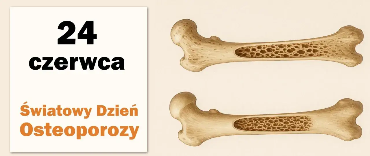 24 czerwca, Światowy Dzień Osteoporozy. Ilustracja porównuje zdrowe i chore kości, podkreślając znaczenie nowoczesnego leczenia osteoporozy.