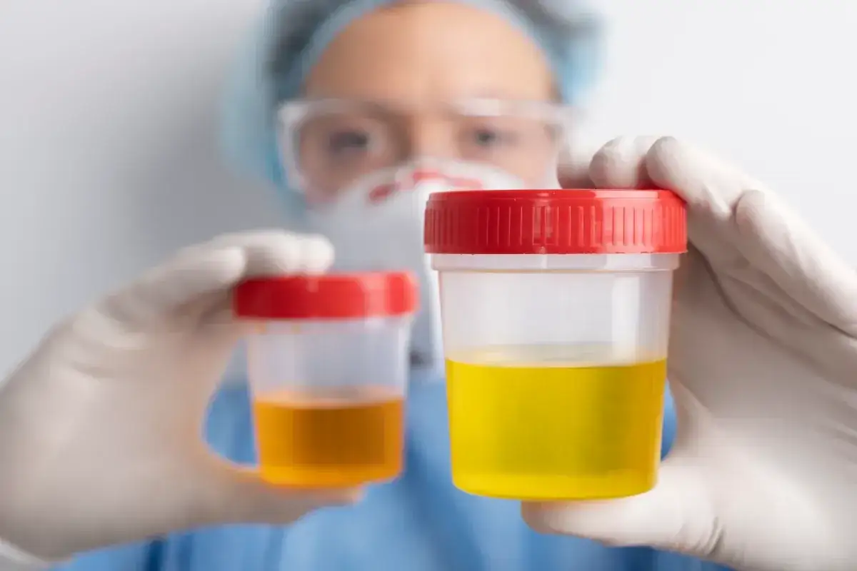 Medyk w rękawiczkach trzyma pojemniki z próbkami moczu. Zwraca uwagę na potencjalny czerwony mocz u dziecka, analizując próbki.