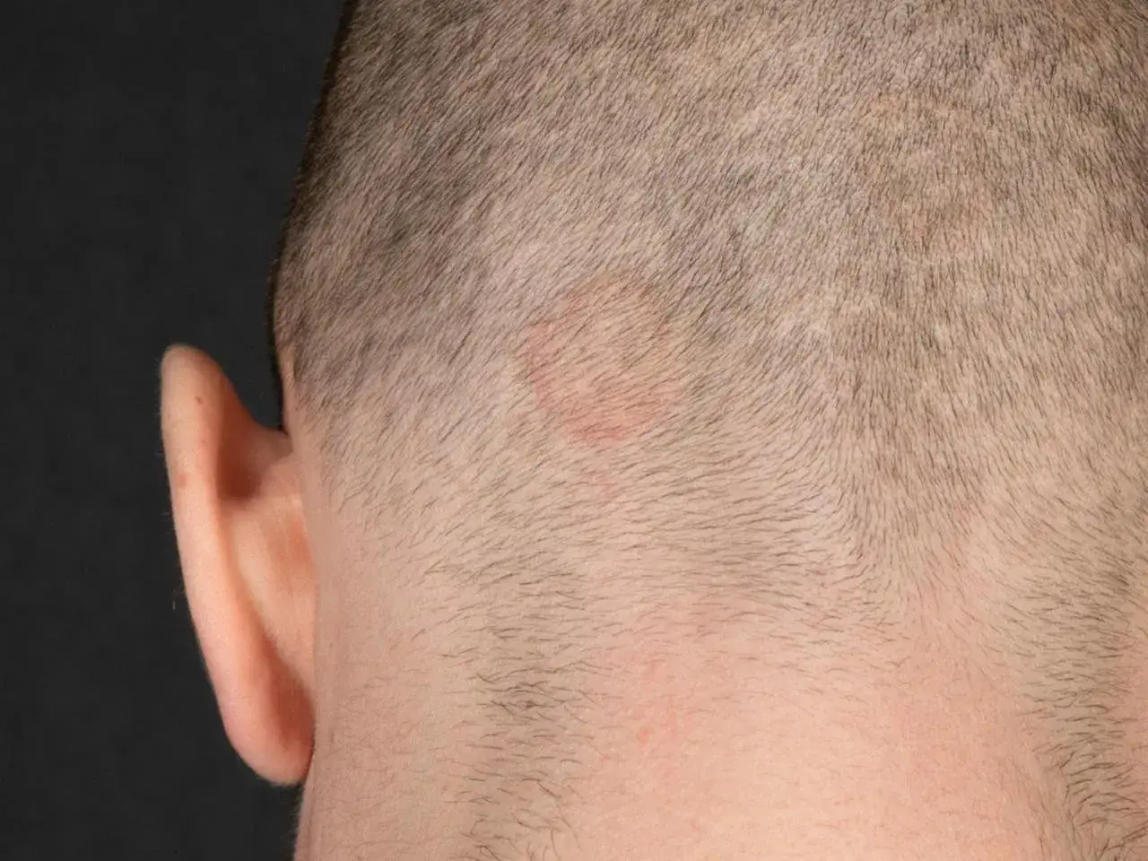 R&ouml;tlicher, ringf&ouml;rmiger Hautausschlag am behaarten Kopf, m&ouml;glicherweise tinea corporis.