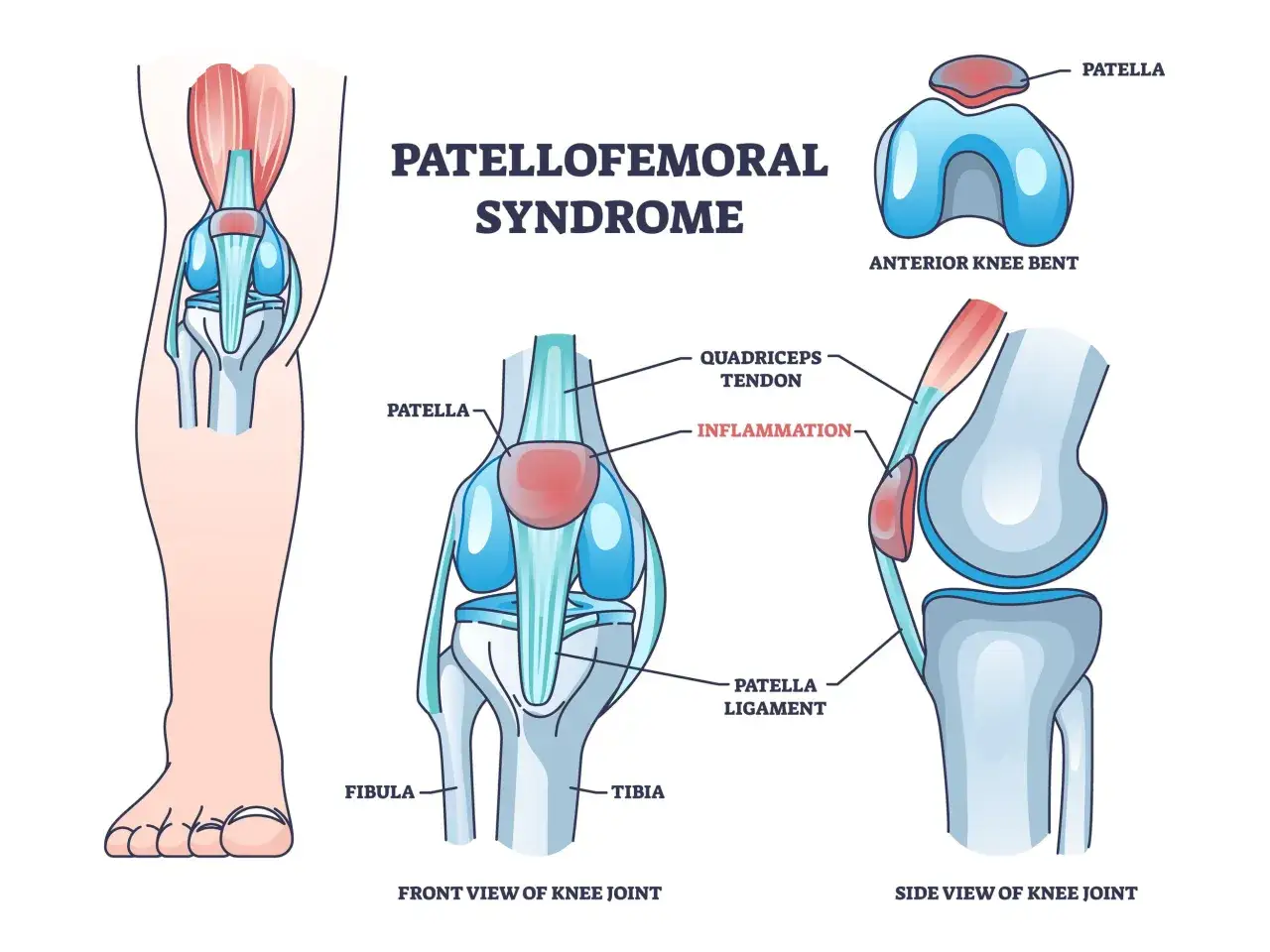 Illustration zeigt das Patellofemoral-Syndrom mit Entzündung im Kniegelenk, die zu Knieschmerzen nach Joggen führen kann.
