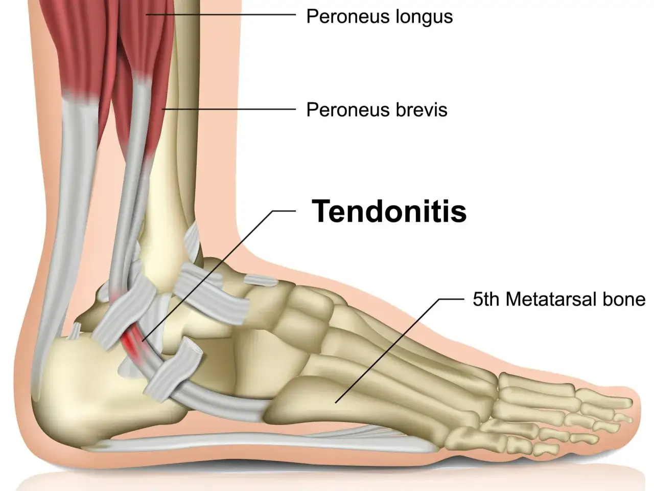 Illustrazione anatomica della caviglia che mostra la tendinite, con i tendini peronei e il quinto metatarso evidenziati.
