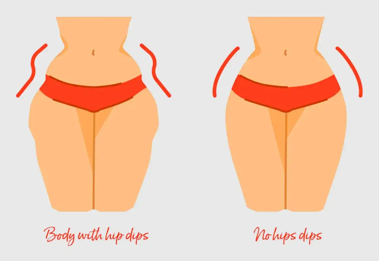 Por&oacute;wnanie sylwetek: po lewej ciało z zagłębieniami biodrowymi (hip dips), po prawej bez. Przyczyny hip dips są naturalne.