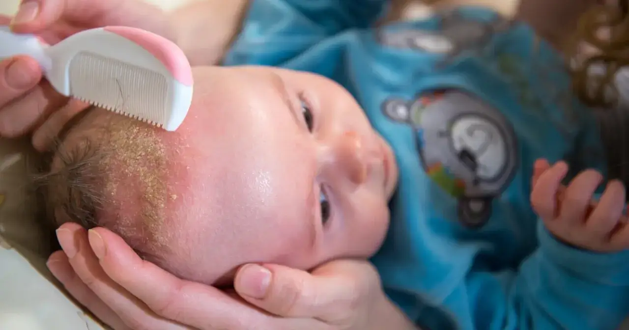 Ein Baby kratzt sich am Kopf, w&auml;hrend eine Hand vorsichtig mit einem Kamm die Schuppen l&ouml;st.