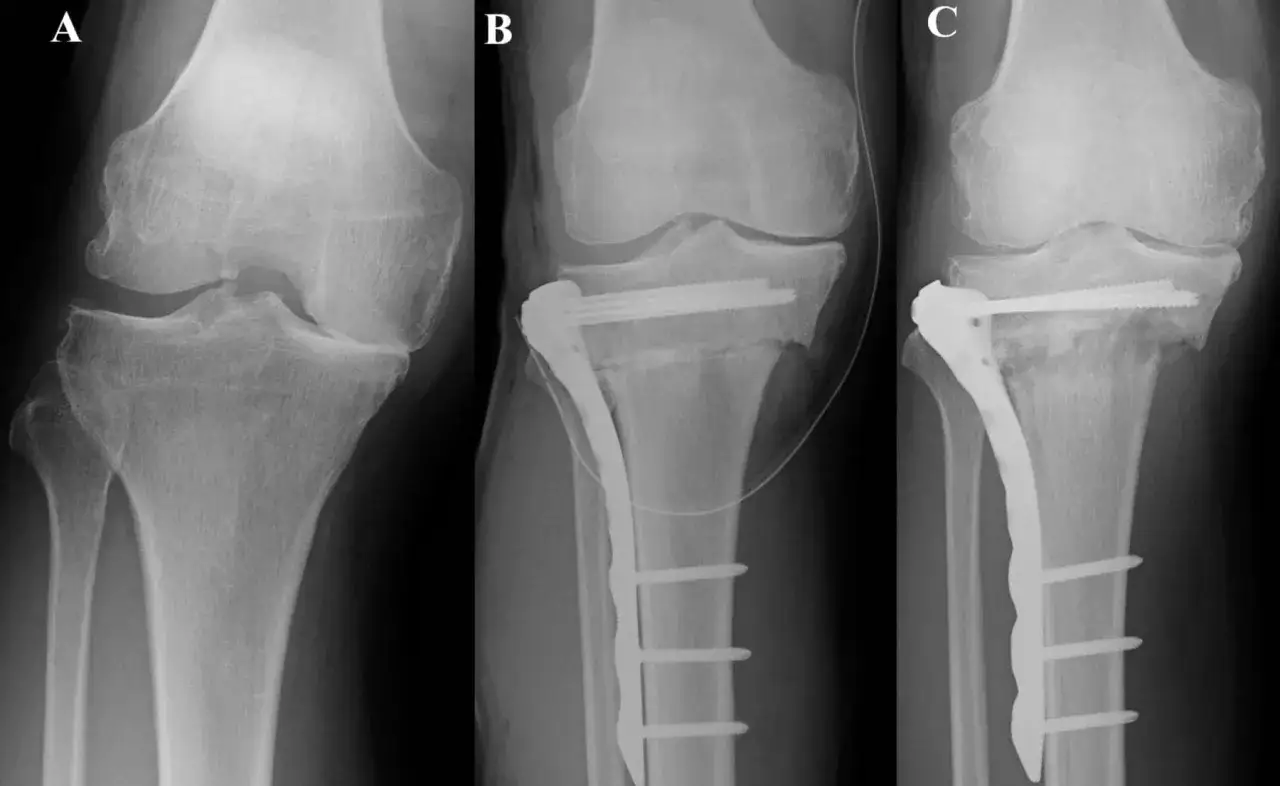Rentgen kolana przed i po zabiegu osteotomii. Widoczne implanty stabilizujące kość.