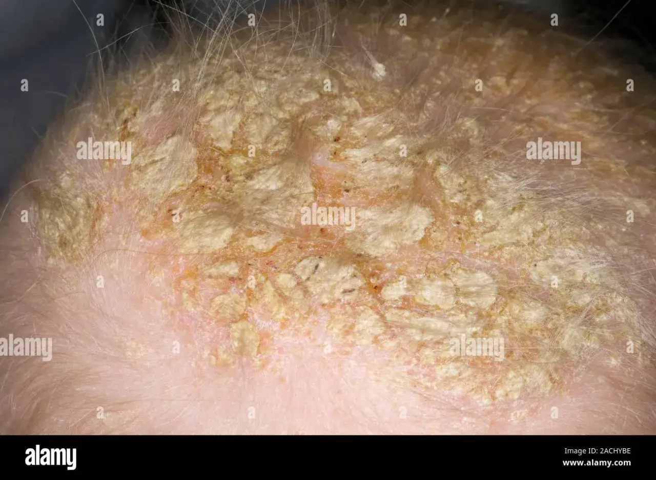 Cutezza del cuoio capelluto con croste giallastre, indicative di dermatite seborroica.