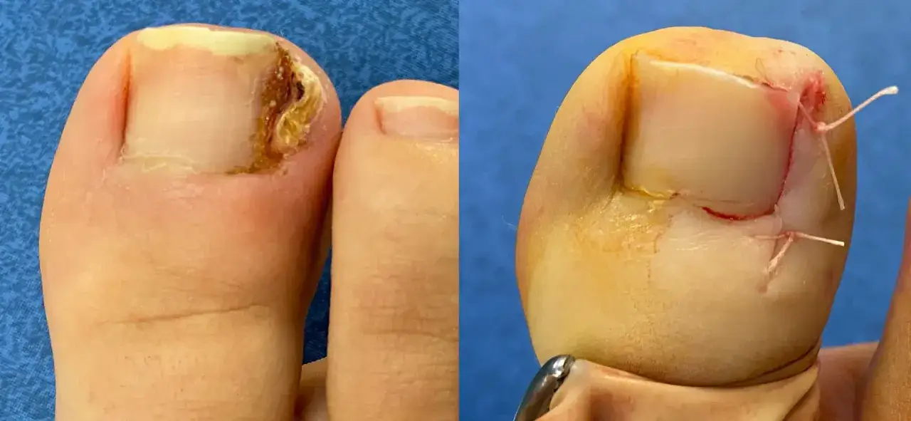 Avant/apr&egrave;s chirurgie d'un ongle incarn&eacute; douloureux par un podologue. Le pied gauche montre l'ongle ab&icirc;m&eacute;, le droit, sutur&eacute;.