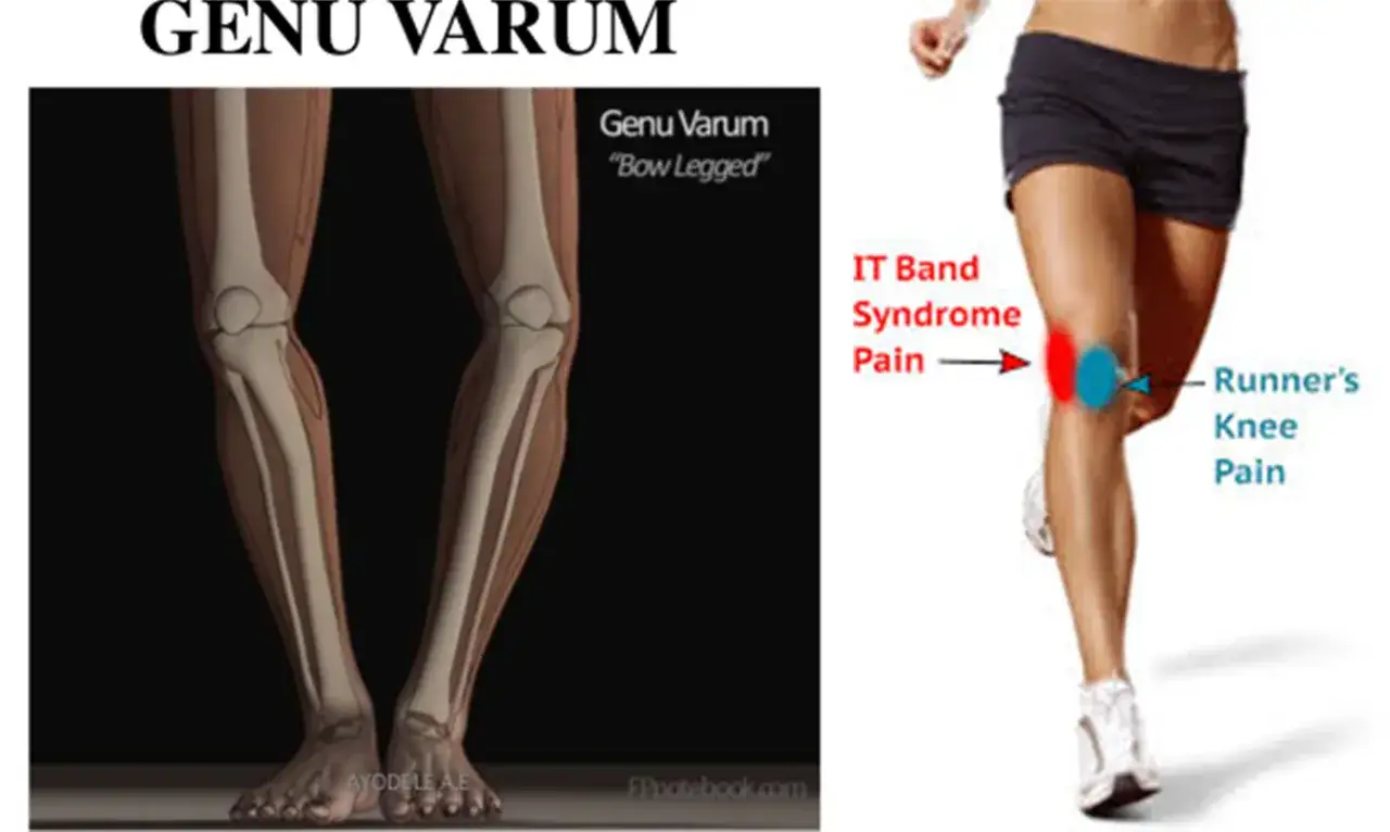 Genu Varum (O-Beine) und Schmerzpunkte am Knie, die auf das IT-Band-Syndrom und Läuferknie hinweisen.