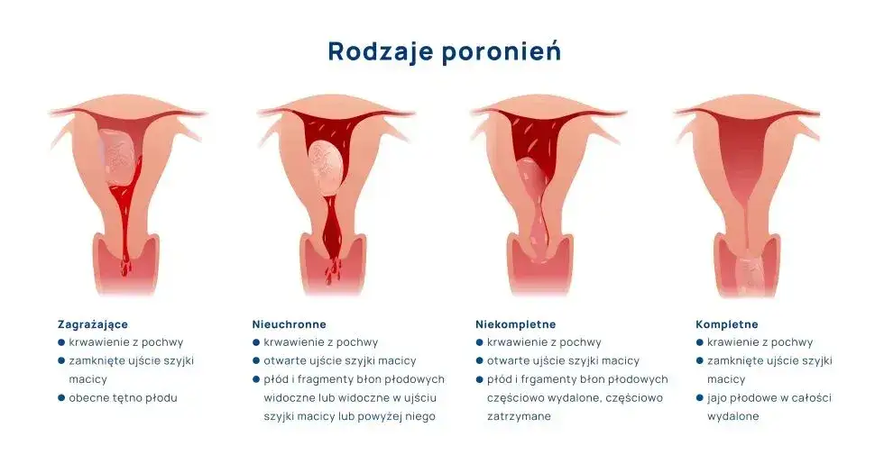 objawy poronienia grafika